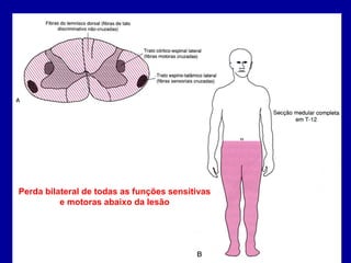 Perda bilateral de todas as funções sensitivas
e motoras abaixo da lesão
 
