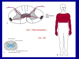 Dor + Tato protopático
C4 – C6
 
