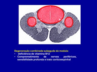 Degeneração combinada subaguda da medula:
• deficiência de vitamina B12
• Comprometimento de nervos periféricos,
sensibilidade profunda e trato corticoespinhal
 