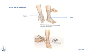 MFMM
bota
luva
NEUROPATIA DIABÉTICA
 