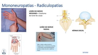 MFMM
Mononeuropatias - Radiculopatias
HÉRNIA DISCAL
LESÃO DO NERVO
RADIAL
LESÃO DO NERVO
MEDIANO=> Síndrome
do túnel do carpo
 