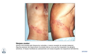 MFMM
Herpes zoster:
doença viral causada pelo Herpesvirus varicellae, o mesmo causador da varicela (catapora).
Algumas pessoas não desenvolvem imunidade total ao vírus que fica hospedado nos gânglios
sensitivos. O herpes manifesta-se cutaneamente com essas erupções nos respectivos dermátomos.
 