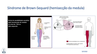 MFMM
Síndrome de Brown-Sequard (hemisecção da medula)
 