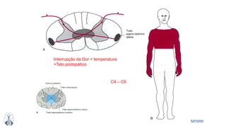 MFMM
Interrupção da Dor + temperatura
+Tato protopático
C4 – C6
 
