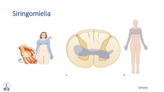 MFMM
Siringomielia
 