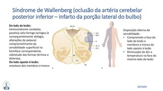 MFMM
Síndrome de Wallenberg (oclusão da artéria cerebelar
posterior inferior – infarto da porção lateral do bulbo)
Disposição alterna da
sensibilidade:
• Compromete a face do
lado da lesão e
membros e tronco do
lado oposto à lesão
• Diminuição da dor e
temperatura na face do
mesmo lado da lesão
Do lado da lesão:
hemissíndrome cerebelar,
paralisia velo-faringo-laríngea (e
consequentemente disfagia,
alterações da palavra)
comprometimento da
sensibilidade superficial na
hemiface correspondente,
sobretudo das formas térmica e
dolorosa;
Do lado oposto à lesão:
anestesia dos membros e tronco
 