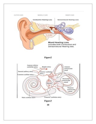 Sensorineural deafness 2018 | PDF