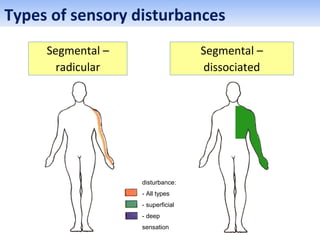 Segmental –
radicular
Segmental –
dissociated
disturbance:
- All types
- superficial
- deep
sensation
Types of sensory disturbances
 