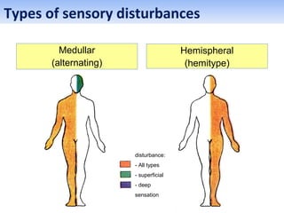 Medullar
(alternating)
Hemispheral
(hemitype)
disturbance:
- All types
- superficial
- deep
sensation
Types of sensory disturbances
 