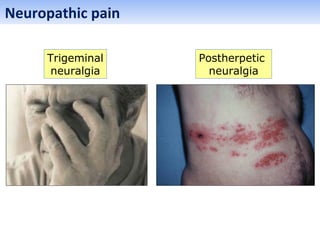 Neuropathic pain
Trigeminal
neuralgia
Postherpetic
neuralgia
 