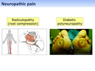 Diabetic
polyneuropathy
Radiculopathy
(root compression)
Neuropathic pain
 