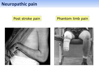 Phantom limb painPost stroke pain
Neuropathic pain
 