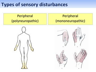 Peripheral
(polyneuropathic)
Peripheral
(mononeuropathic)
Types of sensory disturbances
 