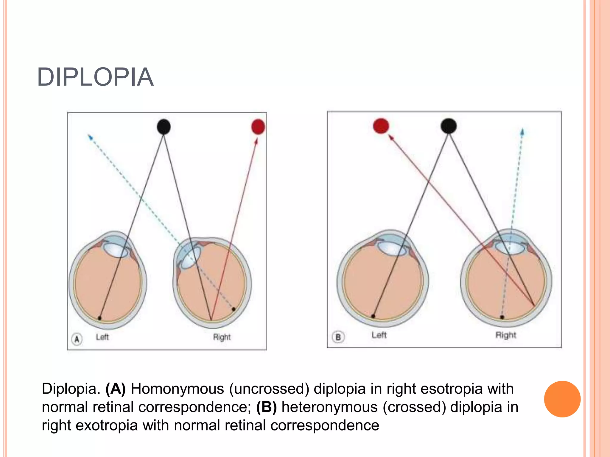 Sensory evaluation of squint
