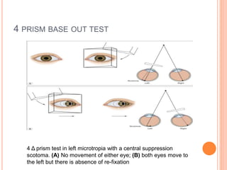 Sensory evaluation of squint | PPTX