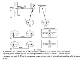 Sensory evaluation of strabismus | PPT