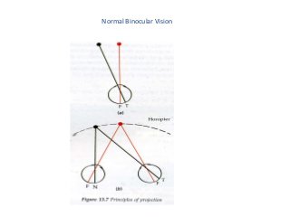 Sensory evaluation of strabismus | PPT