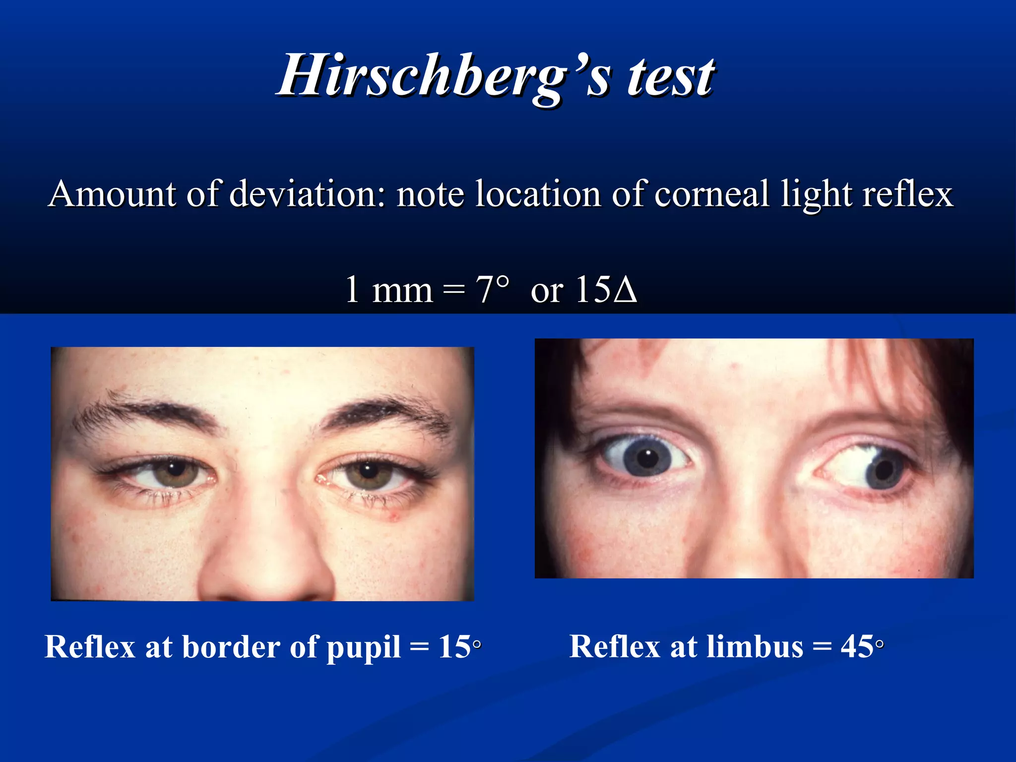 Hirschberg Test Normal Sensory & motor evaluation of strabismus | PPT