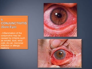 - Inflammation of the
conjunctiva may be
caused by irritants such
as smoke, dust, wind
cold, dry air, micronial
infection or allergic
reations
 