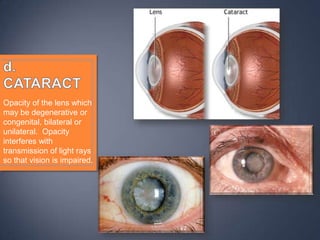 Opacity of the lens which
may be degenerative or
congenital, bilateral or
unilateral. Opacity
interferes with
transmission of light rays
so that vision is impaired.
 