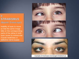Inability of eyes to move
so that the same image
falls on the corresponding
parts of the retina in both
eyes cause by extraocular
muscle weakness or
defective nerve supply
 