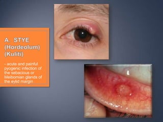 - acute and painful
pyogenic infection of
the sebacious or
Meibomian glands of
the eylid margin
 
