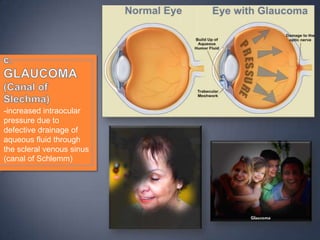 -increased intraocular
pressure due to
defective drainage of
aqueous fluid through
the scleral venous sinus
(canal of Schlemm)
 