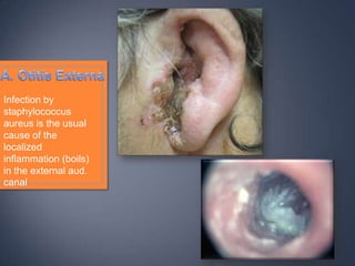 Infection by
staphylococcus
aureus is the usual
cause of the
localized
inflammation (boils)
in the external aud.
canal
 