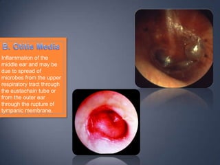 Inflammation of the
middle ear and may be
due to spread of
microbes from the upper
respiratory tract through
the eustachain tube or
from the outer ear
through the rupture of
tympanic membrane.
 