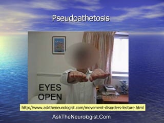 Pseudoathetosis  http://www.asktheneurologist.com/movement-disorders-lecture.html 