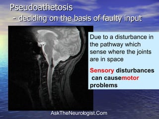 Pseudoathetosis  -  deciding on the basis of faulty input Due to a disturbance in the pathway which sense where the joints are in space Sensory  disturbances can cause  motor  problems 