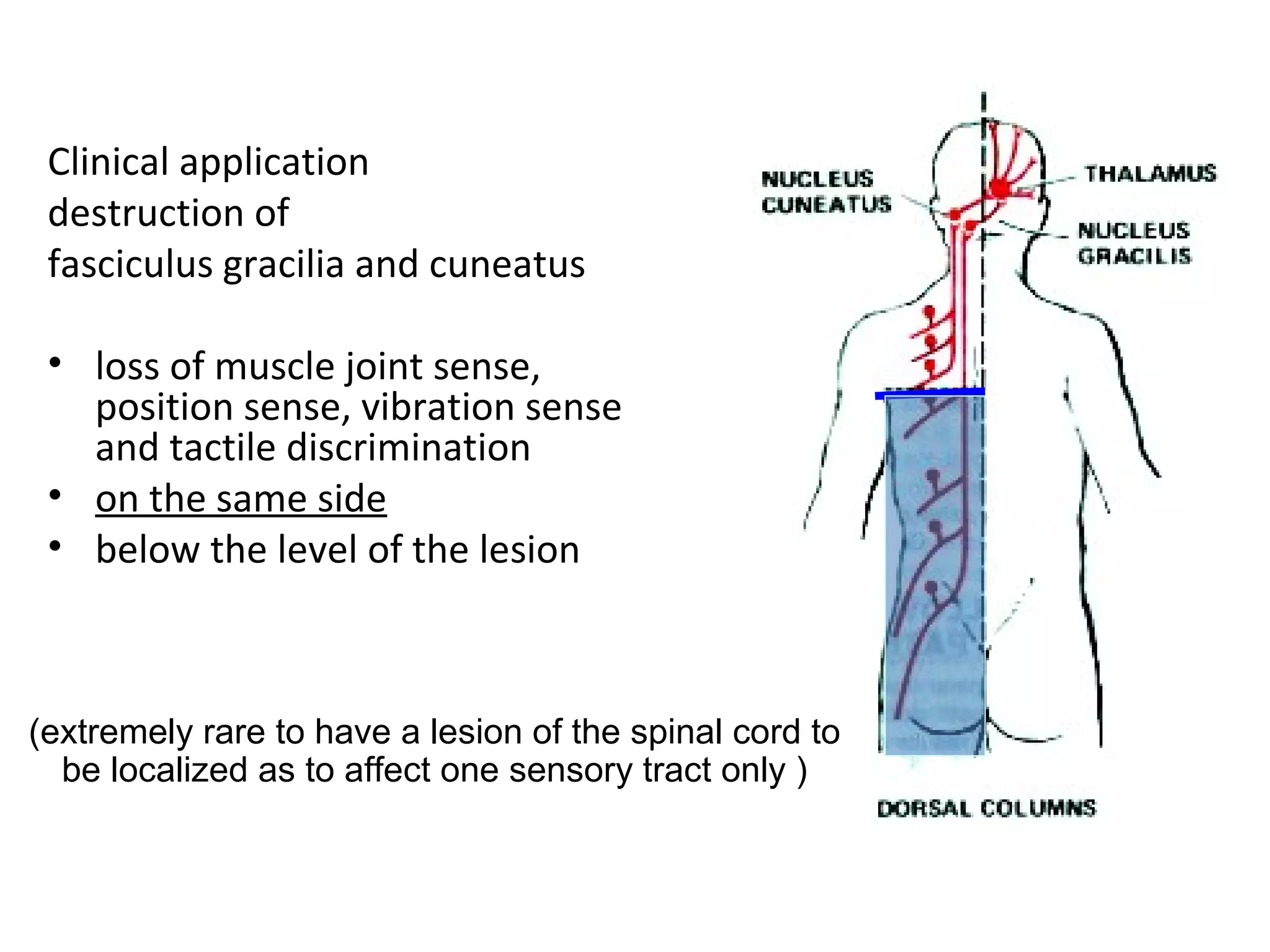 Clinical application
destruction of
fasciculus gracilia and cuneatus
• loss of muscle joint sense,
position sense, vibration sense
and tactile discrimination
• on the same side
• below the level of the lesion
(extremely rare to have a lesion of the spinal cord to
be localized as to affect one sensory tract only )
 