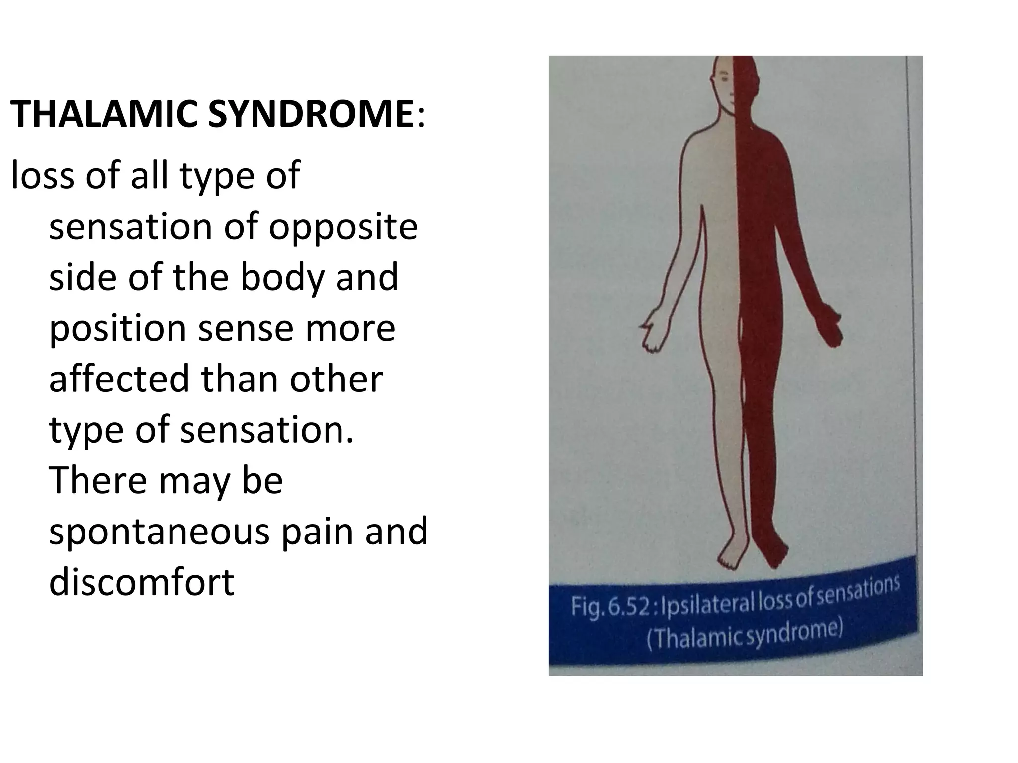 THALAMIC SYNDROME:
loss of all type of
sensation of opposite
side of the body and
position sense more
affected than other
type of sensation.
There may be
spontaneous pain and
discomfort
 
