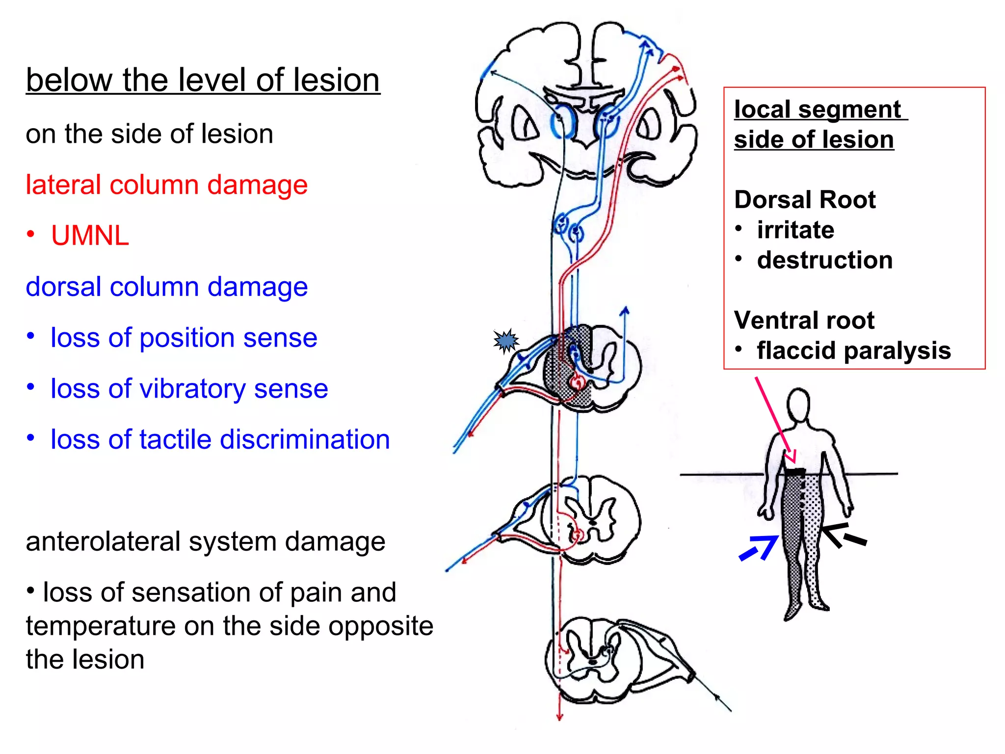 below the level of lesion
on the side of lesion
lateral column damage
• UMNL
dorsal column damage
• loss of position sense
• loss of vibratory sense
• loss of tactile discrimination
anterolateral system damage
• loss of sensation of pain and
temperature on the side opposite
the lesion
local segment
side of lesion
Dorsal Root
• irritate
• destruction
Ventral root
• flaccid paralysis
 