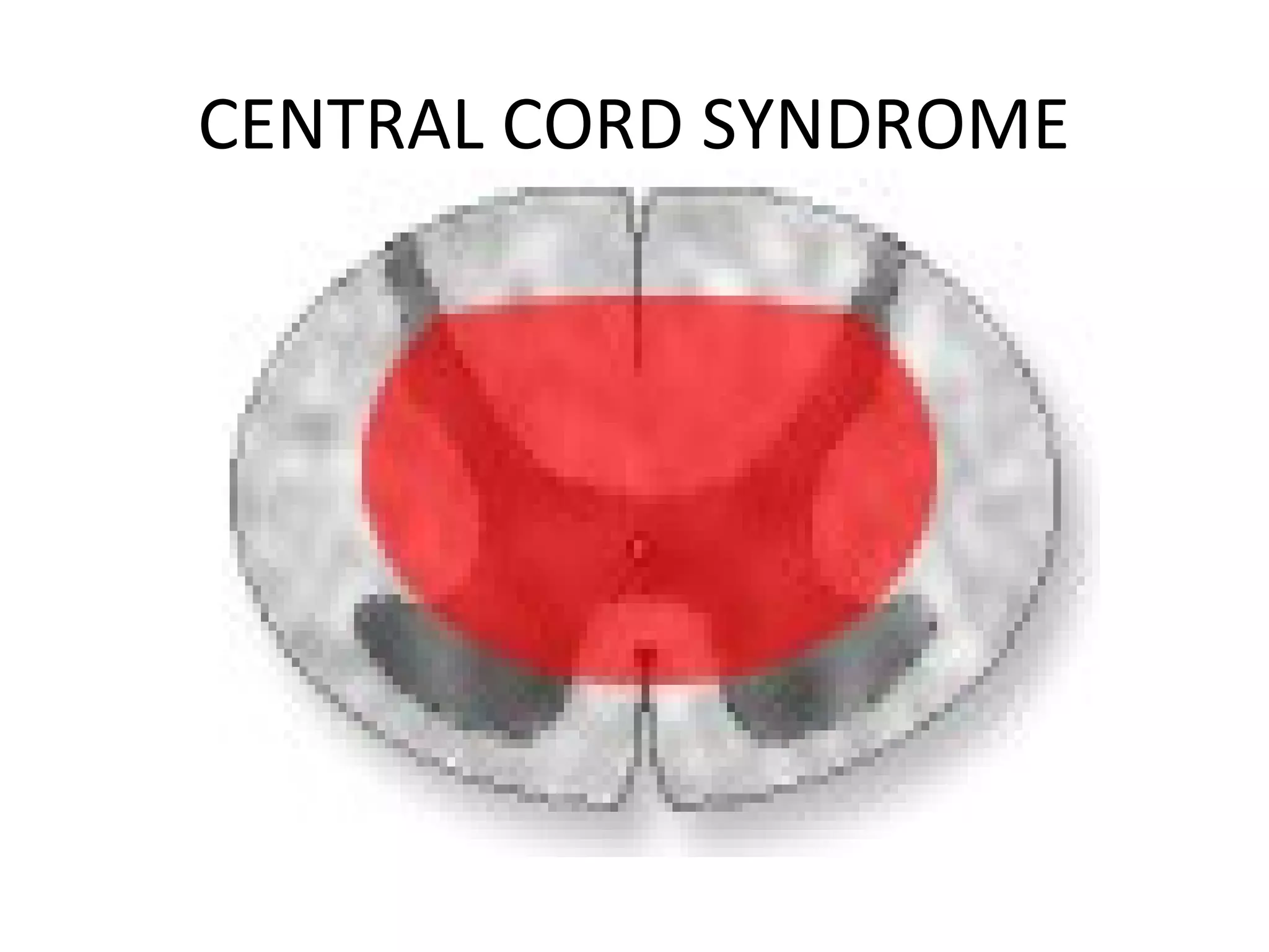 CENTRAL CORD SYNDROME
 