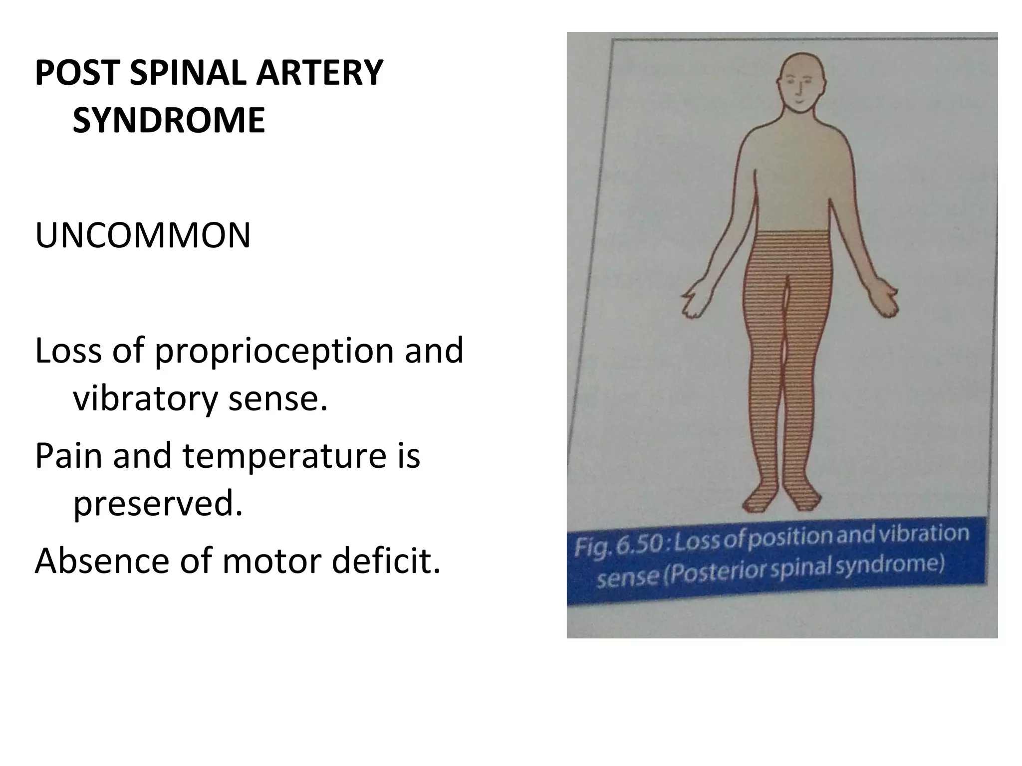 POST SPINAL ARTERY
SYNDROME
UNCOMMON
Loss of proprioception and
vibratory sense.
Pain and temperature is
preserved.
Absence of motor deficit.
 