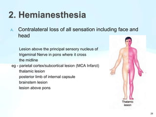 28
2. Hemianesthesia
A. Contralateral loss of all sensation including face and
head
Lesion above the principal sensory nucleus of
trigeminal Nerve in pons where it cross
the midline
eg - parietal cortex/subcortical lesion (MCA Infarct)
thalamic lesion
posterior limb of internal capsule
brainstem lesion
lesion above pons
 