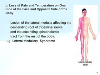 29
b. Loss of Pain and Temperature on One
Side of the Face and Opposite Side of the
Body
• Lesion of the lateral medulla affecting the
descending root of trigeminal nerve
and the ascending spinothalamic
tract from the rest of the body.
Eg Lateral Medullary Syndrome
 