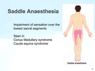 Saddle Anaesthesia
34
Impairment of sensation over the
lowest sacral segments
Seen in
Conus Medullary syndrome
Cauda equina syndrome
 
