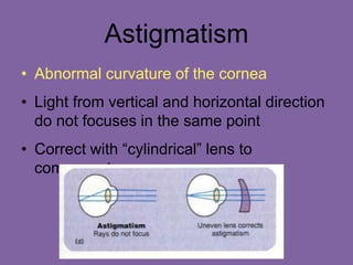 Astigmatism
• Abnormal curvature of the cornea
• Light from vertical and horizontal direction
do not focuses in the same point
• Correct with “cylindrical” lens to
compensate
 