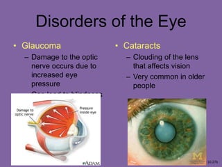 Disorders of the Eye
• Glaucoma
– Damage to the optic
nerve occurs due to
increased eye
pressure
– Can lead to blindness
• Cataracts
– Clouding of the lens
that affects vision
– Very common in older
people
Figure 10.27b
 