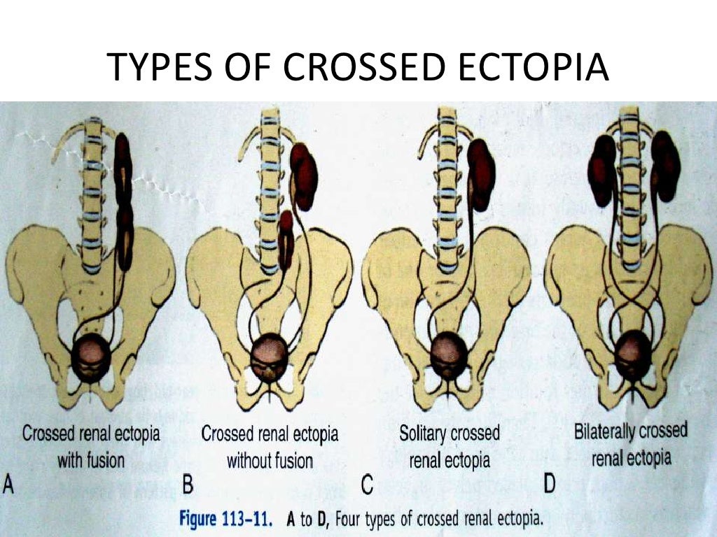 A Case of Horseshoe Kidney