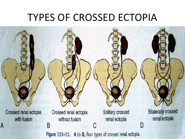 A Case of Horseshoe Kidney