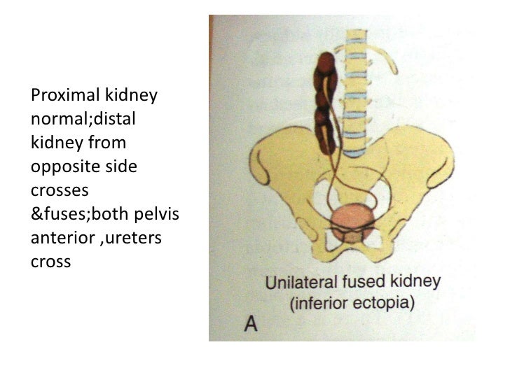 A Case of Horseshoe Kidney