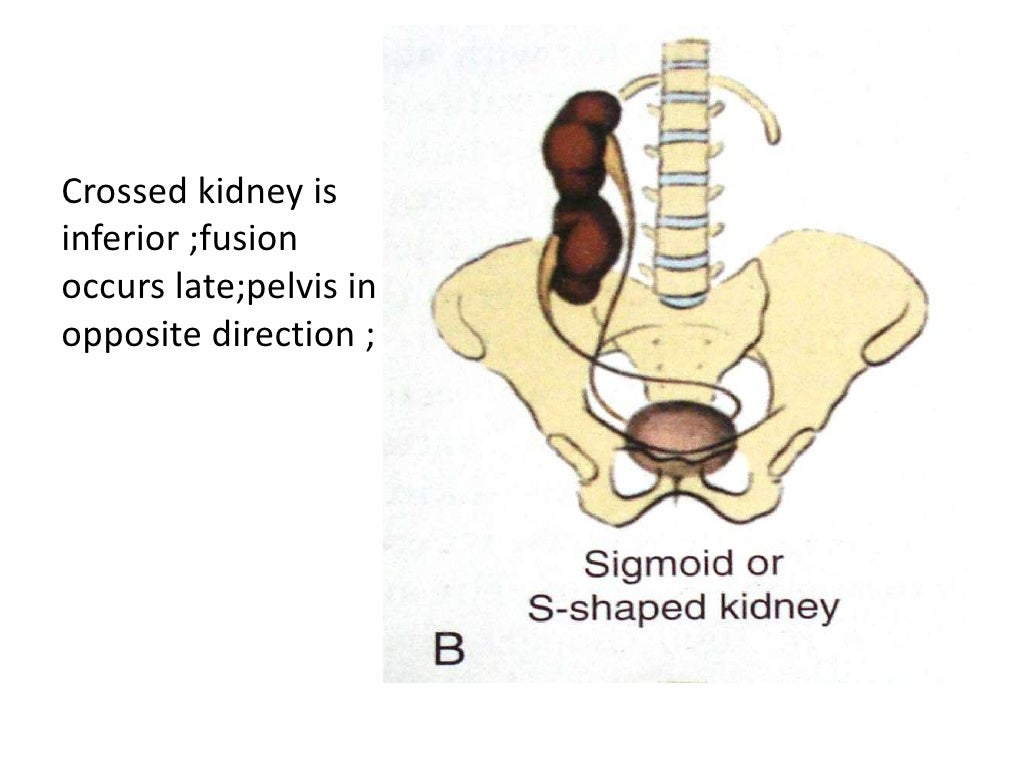 A Case of Horseshoe Kidney