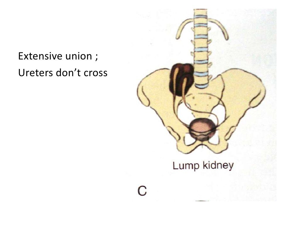 A Case of Horseshoe Kidney