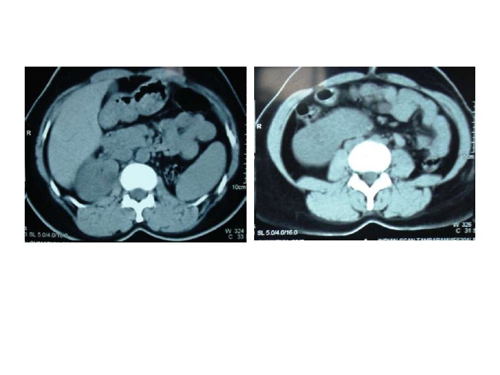 A Case of Horseshoe Kidney