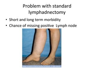 Problem	
  with	
  standard	
  
lymphadnectomy	
  
•  Short	
  and	
  long	
  term	
  morbidity	
  
•  Chance	
  of	
  missing	
  posi$ve	
  	
  Lymph	
  node	
  	
  
 