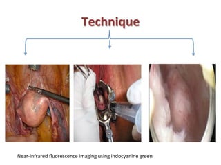 Technique	
  
Near-­‐infrared	
  ﬂuorescence	
  imaging	
  using	
  indocyanine	
  green	
  
 