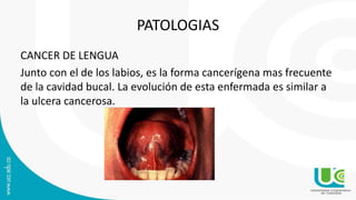 PATOLOGIAS
CANCER DE LENGUA
Junto con el de los labios, es la forma cancerígena mas frecuente
de la cavidad bucal. La evolución de esta enfermada es similar a
la ulcera cancerosa.
 